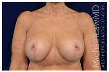 Breast Augmentation After Photo by Michael Law, MD; Raleigh, NC - Case 33169