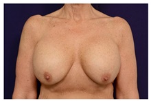 Breast Augmentation Before Photo by Michael Law, MD; Raleigh, NC - Case 33169