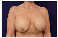 Breast Augmentation Before Photo by Michael Law, MD; Raleigh, NC - Case 33169