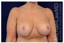 Breast Augmentation After Photo by Michael Law, MD; Raleigh, NC - Case 33172