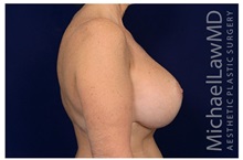 Breast Augmentation After Photo by Michael Law, MD; Raleigh, NC - Case 33172