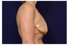 Breast Augmentation Before Photo by Michael Law, MD; Raleigh, NC - Case 33172