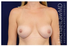 Breast Augmentation After Photo by Michael Law, MD; Raleigh, NC - Case 33175