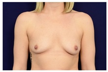 Breast Augmentation Before Photo by Michael Law, MD; Raleigh, NC - Case 33175