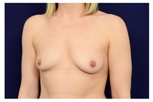 Breast Augmentation Before Photo by Michael Law, MD; Raleigh, NC - Case 33175