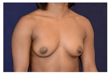 Breast Augmentation Before Photo by Michael Law, MD; Raleigh, NC - Case 33176