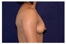 Breast Augmentation Before Photo by Michael Law, MD; Raleigh, NC - Case 33176