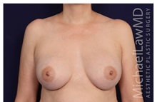 Breast Augmentation After Photo by Michael Law, MD; Raleigh, NC - Case 33178