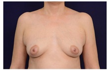 Breast Augmentation Before Photo by Michael Law, MD; Raleigh, NC - Case 33178