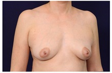 Breast Augmentation Before Photo by Michael Law, MD; Raleigh, NC - Case 33178