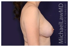 Breast Augmentation After Photo by Michael Law, MD; Raleigh, NC - Case 33178