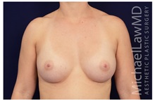 Breast Augmentation After Photo by Michael Law, MD; Raleigh, NC - Case 33179