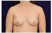 Breast Augmentation Before Photo by Michael Law, MD; Raleigh, NC - Case 33179