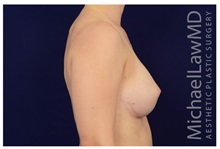 Breast Augmentation After Photo by Michael Law, MD; Raleigh, NC - Case 33179
