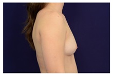 Breast Augmentation Before Photo by Michael Law, MD; Raleigh, NC - Case 33179