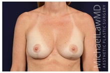 Breast Augmentation After Photo by Michael Law, MD; Raleigh, NC - Case 33180
