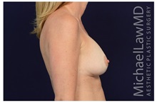 Breast Augmentation After Photo by Michael Law, MD; Raleigh, NC - Case 33180