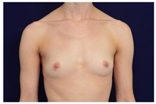 Breast Augmentation Before Photo by Michael Law, MD; Raleigh, NC - Case 33181