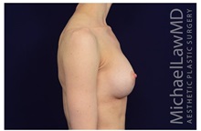 Breast Augmentation After Photo by Michael Law, MD; Raleigh, NC - Case 33181