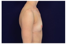 Breast Augmentation Before Photo by Michael Law, MD; Raleigh, NC - Case 33181