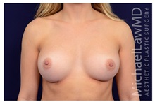 Breast Augmentation After Photo by Michael Law, MD; Raleigh, NC - Case 33182
