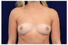 Breast Augmentation Before Photo by Michael Law, MD; Raleigh, NC - Case 33182