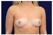 Breast Augmentation Before Photo by Michael Law, MD; Raleigh, NC - Case 33182