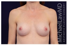 Breast Augmentation After Photo by Michael Law, MD; Raleigh, NC - Case 33183