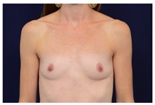 Breast Augmentation Before Photo by Michael Law, MD; Raleigh, NC - Case 33183
