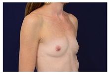 Breast Augmentation Before Photo by Michael Law, MD; Raleigh, NC - Case 33183