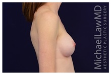 Breast Augmentation After Photo by Michael Law, MD; Raleigh, NC - Case 33183