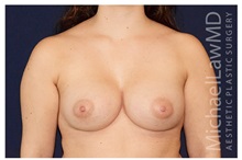 Breast Augmentation After Photo by Michael Law, MD; Raleigh, NC - Case 33184