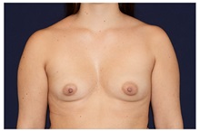 Breast Augmentation Before Photo by Michael Law, MD; Raleigh, NC - Case 33184