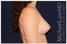 Breast Augmentation After Photo by Michael Law, MD; Raleigh, NC - Case 33184