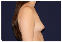 Breast Augmentation Before Photo by Michael Law, MD; Raleigh, NC - Case 33184