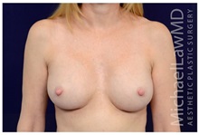 Breast Augmentation After Photo by Michael Law, MD; Raleigh, NC - Case 33186