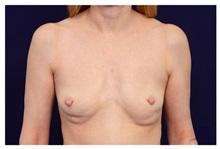 Breast Augmentation Before Photo by Michael Law, MD; Raleigh, NC - Case 33186