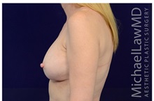Breast Augmentation After Photo by Michael Law, MD; Raleigh, NC - Case 33186