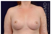 Breast Augmentation After Photo by Michael Law, MD; Raleigh, NC - Case 33192