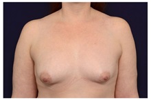 Breast Augmentation Before Photo by Michael Law, MD; Raleigh, NC - Case 33192