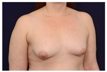 Breast Augmentation Before Photo by Michael Law, MD; Raleigh, NC - Case 33192