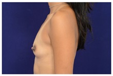 Breast Augmentation Before Photo by Michael Law, MD; Raleigh, NC - Case 33200