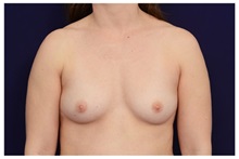 Breast Augmentation Before Photo by Michael Law, MD; Raleigh, NC - Case 33206