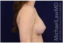 Breast Augmentation After Photo by Michael Law, MD; Raleigh, NC - Case 33206