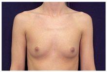 Breast Augmentation Before Photo by Michael Law, MD; Raleigh, NC - Case 33211