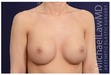 Breast Augmentation After Photo by Michael Law, MD; Raleigh, NC - Case 33211