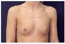 Breast Augmentation Before Photo by Michael Law, MD; Raleigh, NC - Case 33211