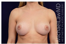 Breast Augmentation After Photo by Michael Law, MD; Raleigh, NC - Case 33218