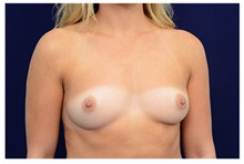 Breast Augmentation Before Photo by Michael Law, MD; Raleigh, NC - Case 33218