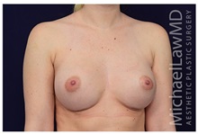 Breast Augmentation After Photo by Michael Law, MD; Raleigh, NC - Case 33222